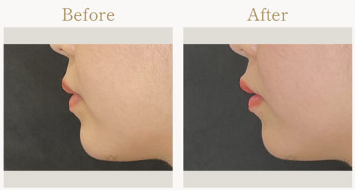 唇ヒアルロン酸 人中短縮ボトックス