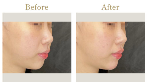 顎ヒアルロン酸