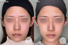 鼻尖形成<br />
耳介軟骨移植