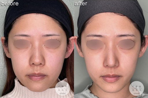 鼻尖形成 耳介軟骨移植