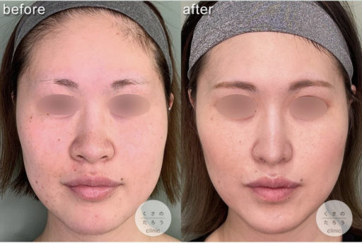 鼻尖形成 耳介軟骨移植 鼻翼縮小