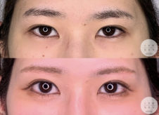 目尻切開<br />
眉下切開