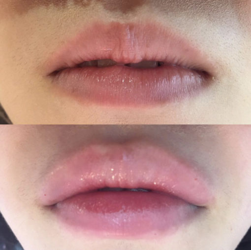 唇ヒアルロン酸