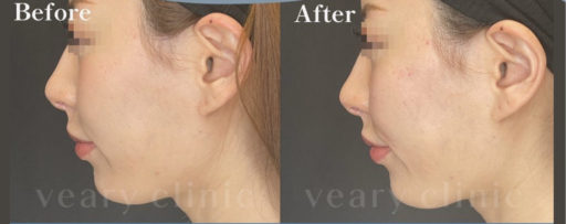 法令線ヒアルロン酸