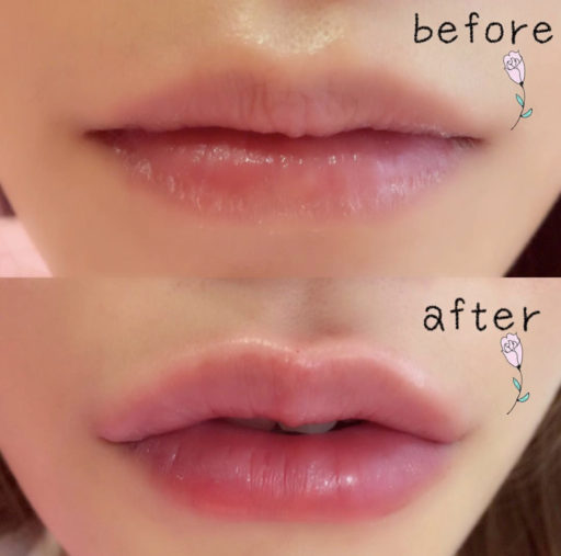 唇ヒアルロン酸