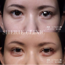 涙袋ヒアルロン酸