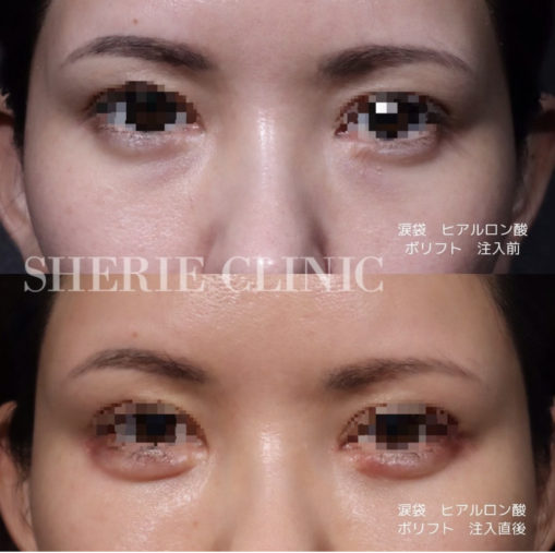 涙袋ヒアルロン酸