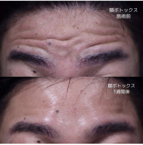 額ボトックス