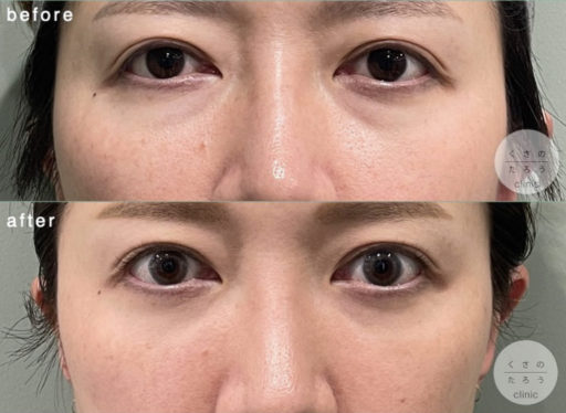 脱脂＋脂肪注入