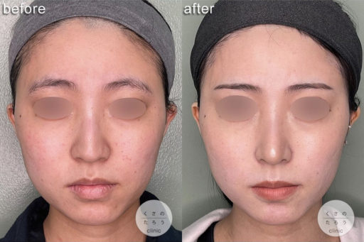 鼻尖形成 耳介軟骨移植