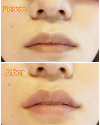 唇ヒアルロン酸