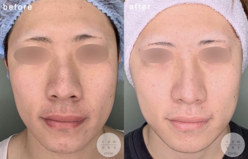 骨切り幅寄せ ハンプ削り 鼻翼縮小 鼻尖形成 耳介軟骨移植