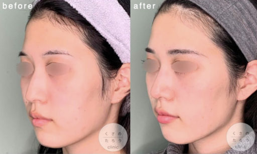 ハンプ削り 耳介軟骨移植