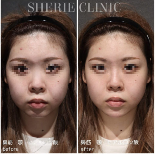 鼻・顎ヒアルロン酸