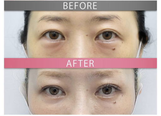 下眼瞼脂肪移動 (裏ハムラ法)