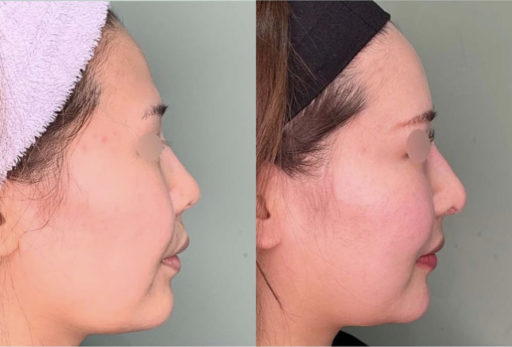 額脂肪注入 鼻中隔延長 シリコンプロテーゼ