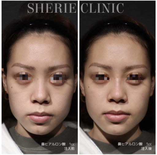 鼻ヒアルロン酸