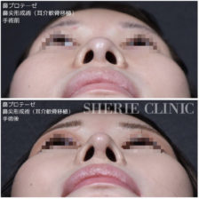 鼻プロテーゼ<br />
鼻尖形成