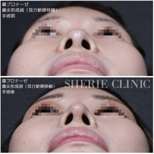 鼻プロテーゼ 鼻尖形成