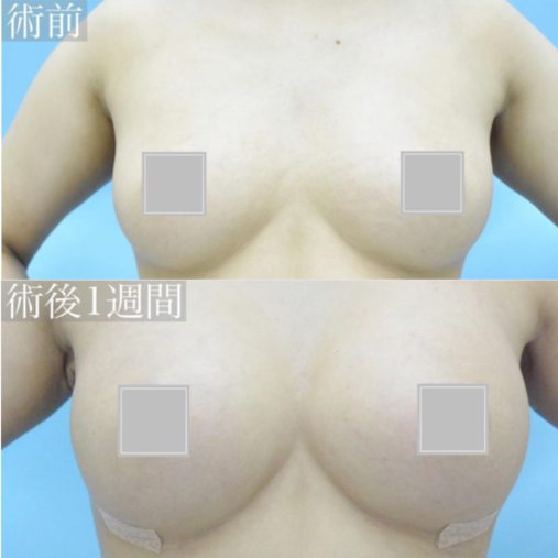 シリコン豊胸