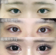 眼瞼下垂<br />
目頭切開