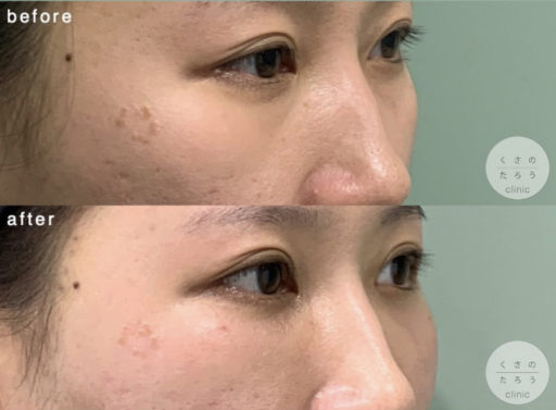 脱脂＋脂肪注入