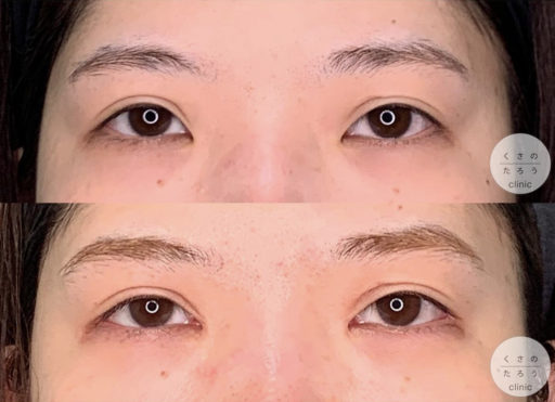 目頭切開 目尻切開