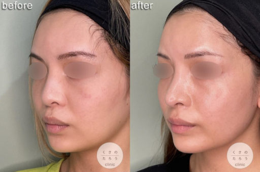 鼻中隔延長 プロテーゼ入れ替え (他院修正)