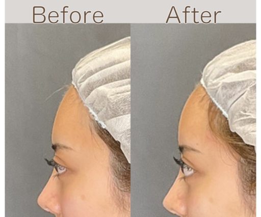 額ヒアルロン酸