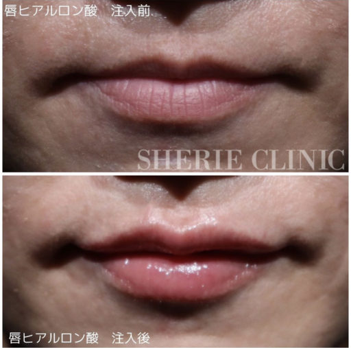 唇ヒアルロン酸