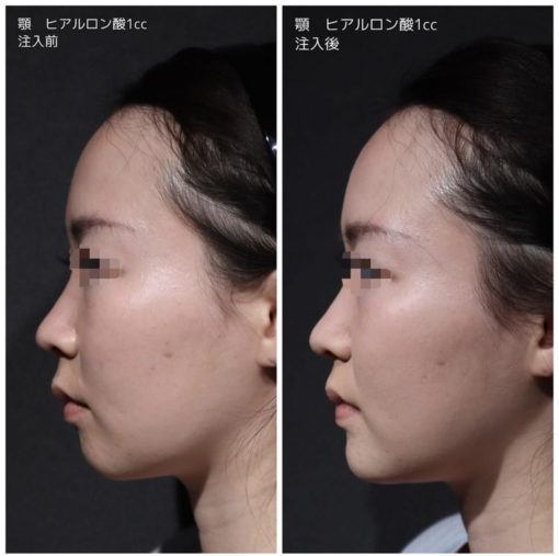 顎ヒアルロン酸