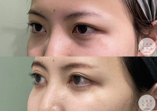 脱脂＋脂肪注入