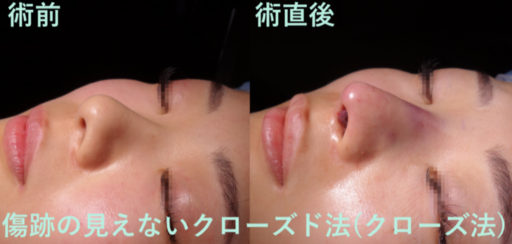 鼻尖形成 鼻中隔延長 シリコンプロテーゼ