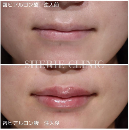唇ヒアルロン酸