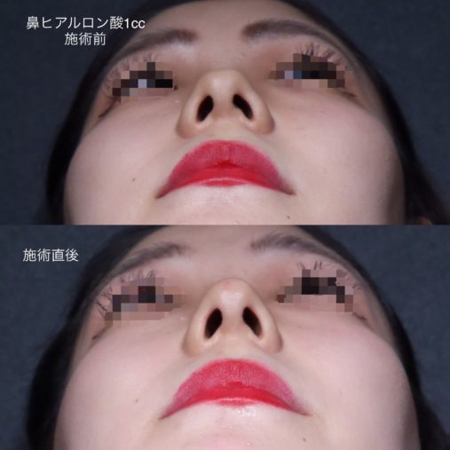 鼻ヒアルロン酸