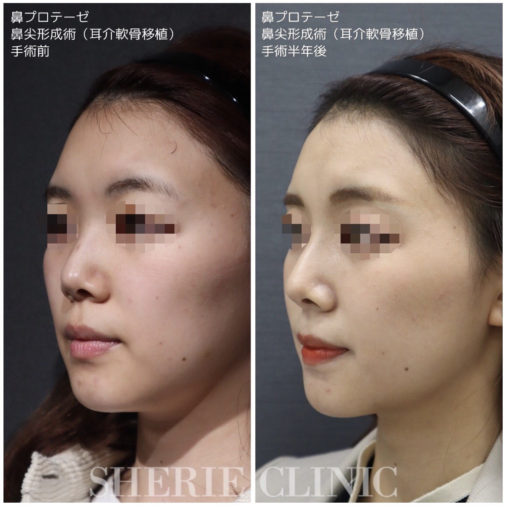鼻プロテーゼ 鼻尖形成