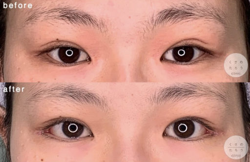 眼瞼下垂 目尻切開