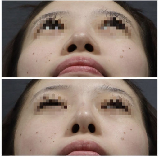 鼻ヒアルロン酸