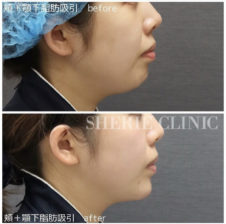 頬・顎下脂肪吸引