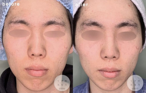 骨切り幅寄せ ハンプ削り 耳介軟骨移植