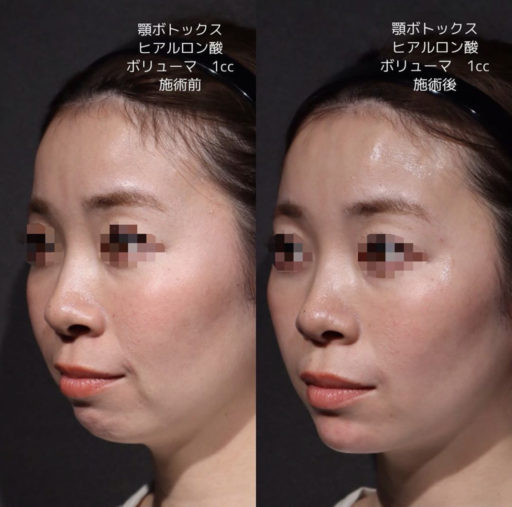 顎ヒアルロン酸 顎ボトックス
