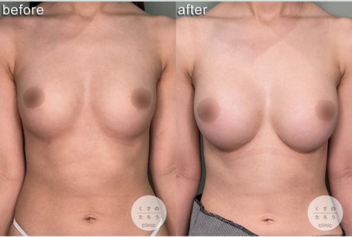 シリコンバッグ豊胸