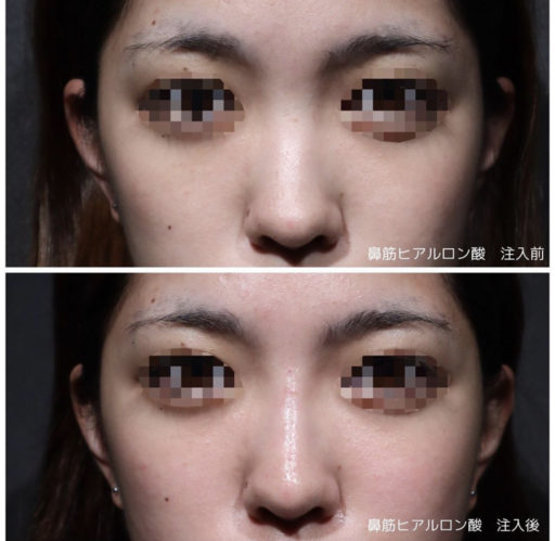 鼻ヒアルロン酸