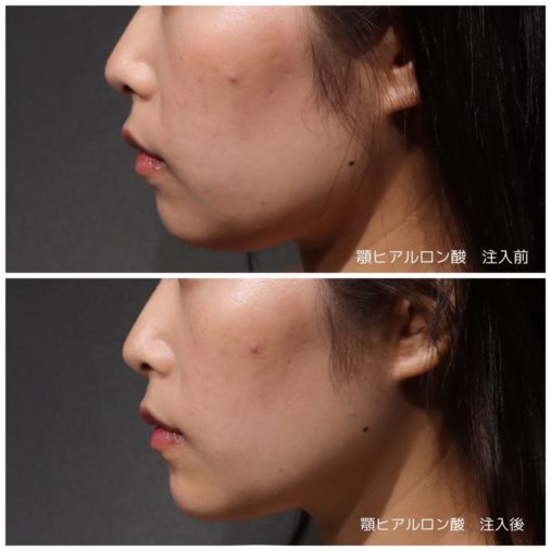 顎ヒアルロン酸