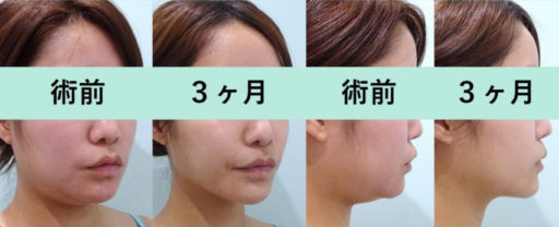 頬・顎下脂肪吸引 エラボトックス