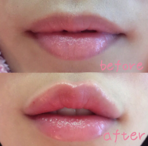 唇ヒアルロン酸