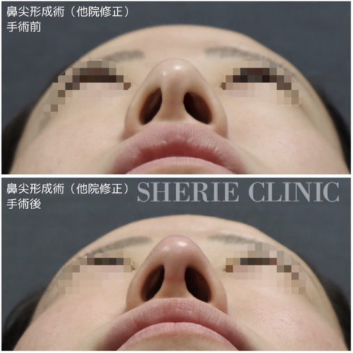 鼻尖形成 (他院修正)