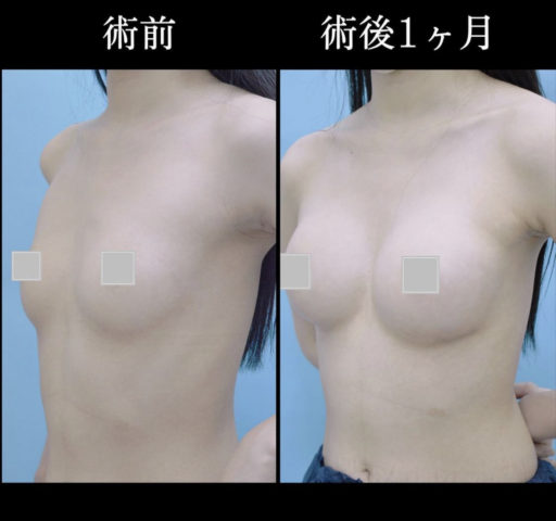 シリコン豊胸