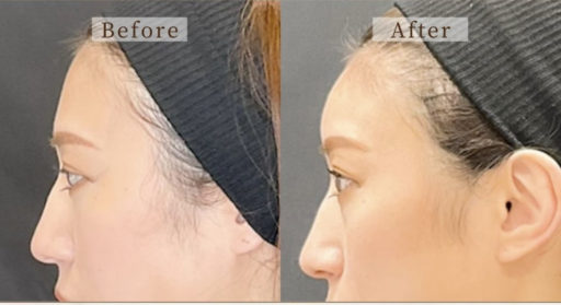 額ヒアルロン酸