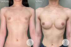 シリコンバッグ豊胸